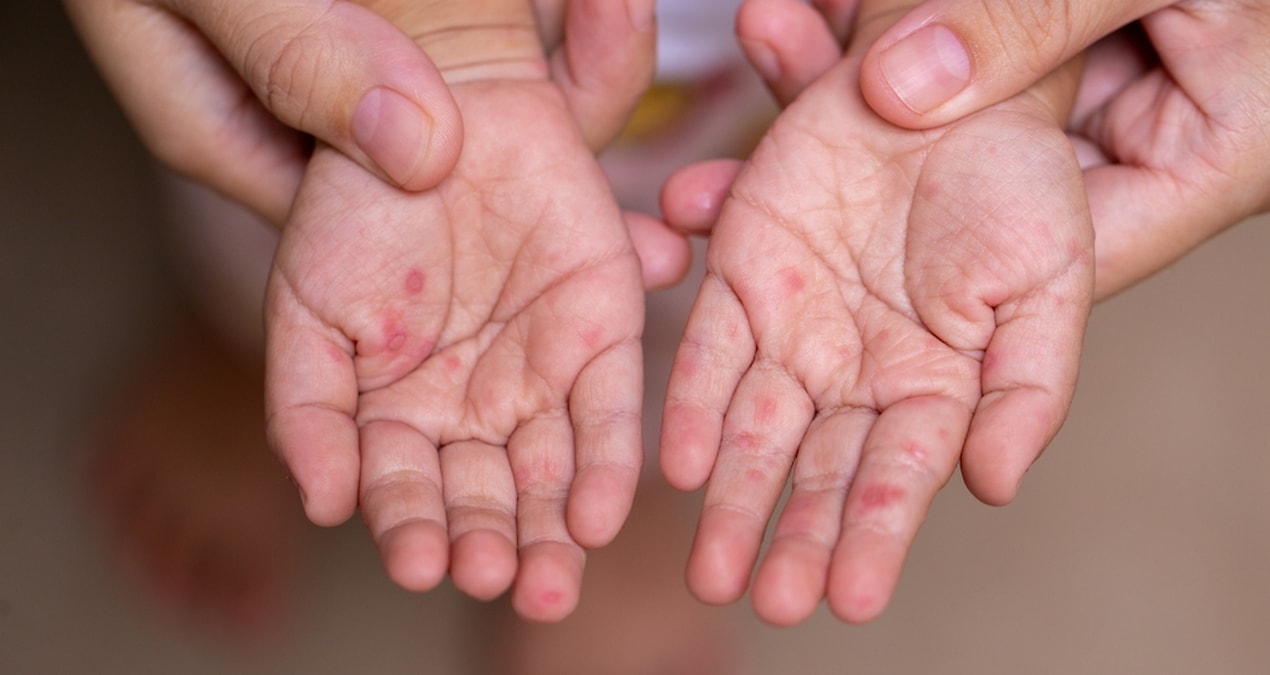 DSÖ ve UNICEF’ten kızamık uyarısı