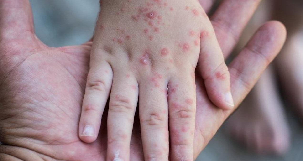 Zona neden olur, bulaşıcı mı?