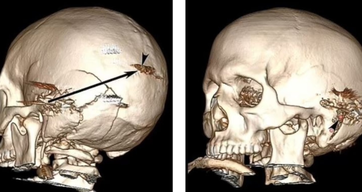 Kafasına ateş açılan adam tıp literatürüne girdi
