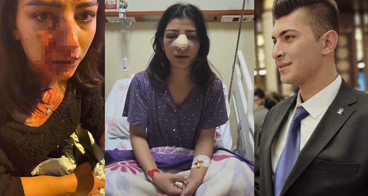 Genç kadının burnunu kıran AKP’li Başkan serbest bırakıldı