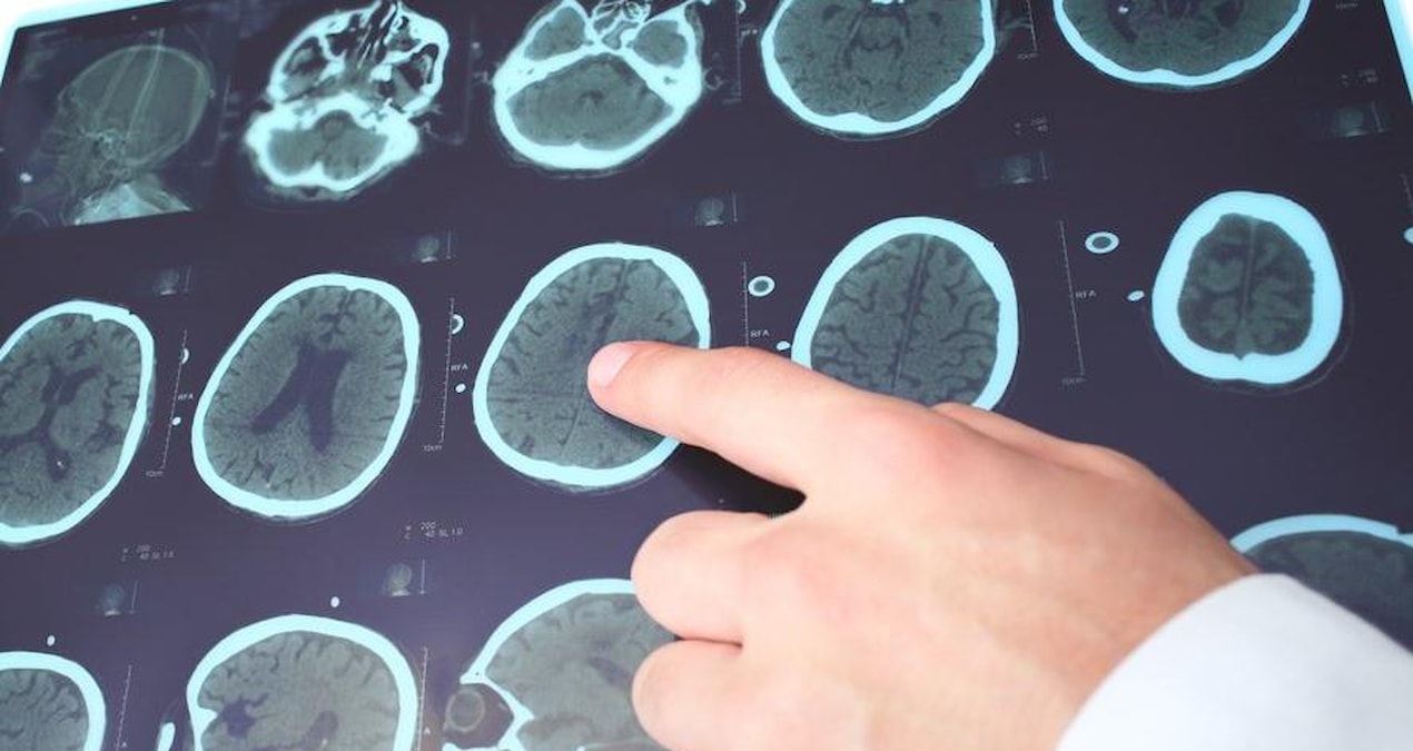 Kadınlarda daha fazla görülüyor… Dikkat çeken belirtileriyle: MS