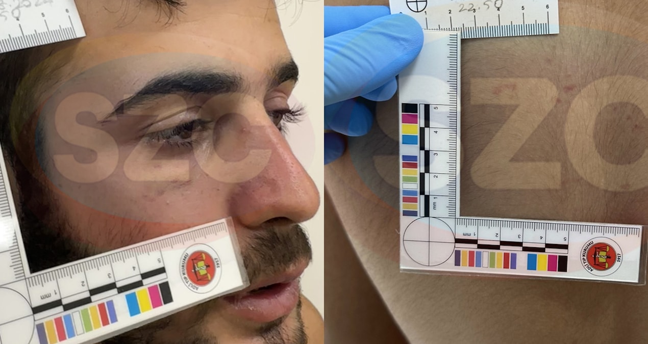 Narin’in tutuklu ağabeyi Enes’in yüzündeki, sırtındaki morluklar ve kolundaki diş izleri ortaya çıktı