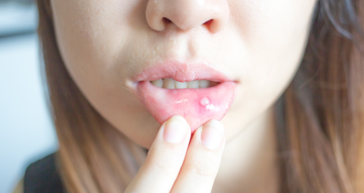 Pamuğa birkaç damla damlatıp sürün! Uçuğa etkisine inanamayacaksınız