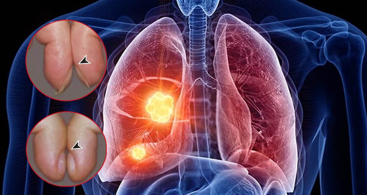 Tırnaklardan akciğer kanseri tespiti: Test 5 saniye sürüyor